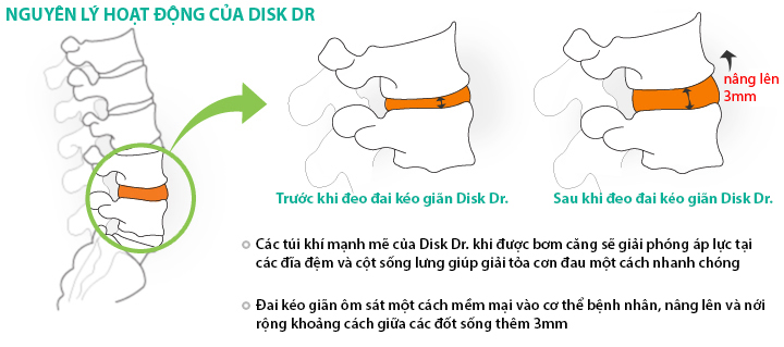 Nguyên lý hoạt động của đai kéo giãn cột sống DiskDr